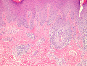 Inflammatory Linear Verrucous Epidermal Naevus pathology