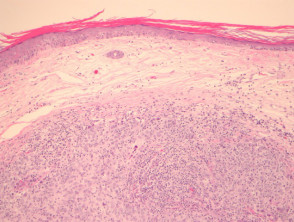 Lymphoepithelioma-like carcinoma pathology