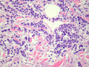 Merkel cell carcinoma pathology