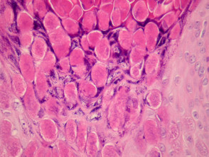 Molluscum contagiosum  pathology