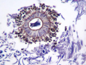 Mycetoma  pathology