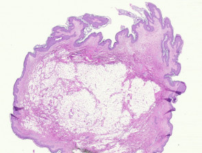 Naevus lipomatosus superficialis pathology