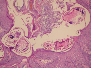Crusted scabies  pathology