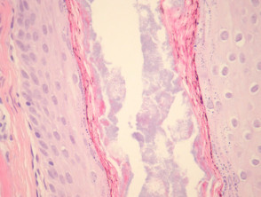 Prurigo pigmentosa pathology