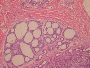 Polymorphous sweat gland carcinoma pathology