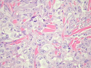 Poorly differentiated squamous cell carcinoma pathology