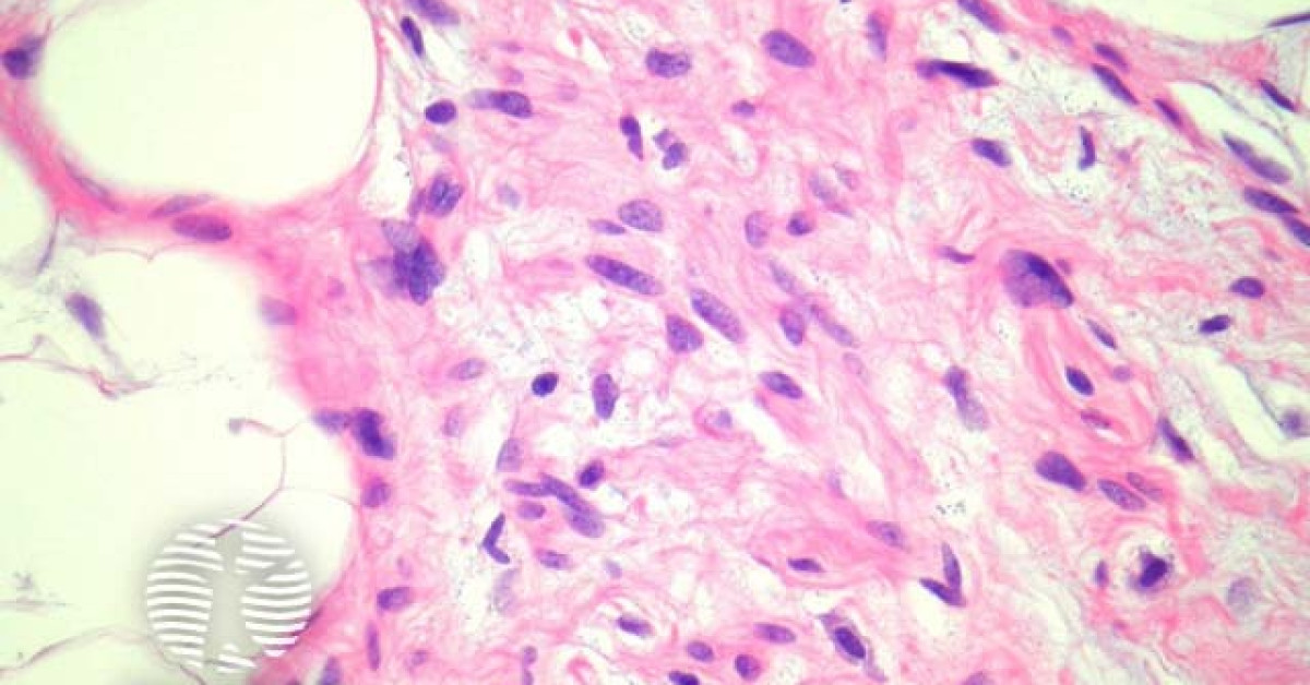 Dermnet Spindle Cell Lipoma Pathology Image