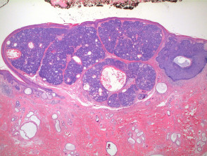 Sebaceoma pathology