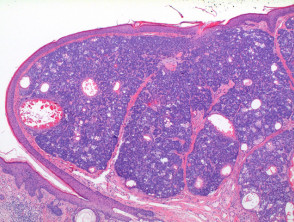 Sebaceoma pathology