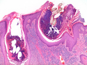 Acne keloidalis nuchae pathology