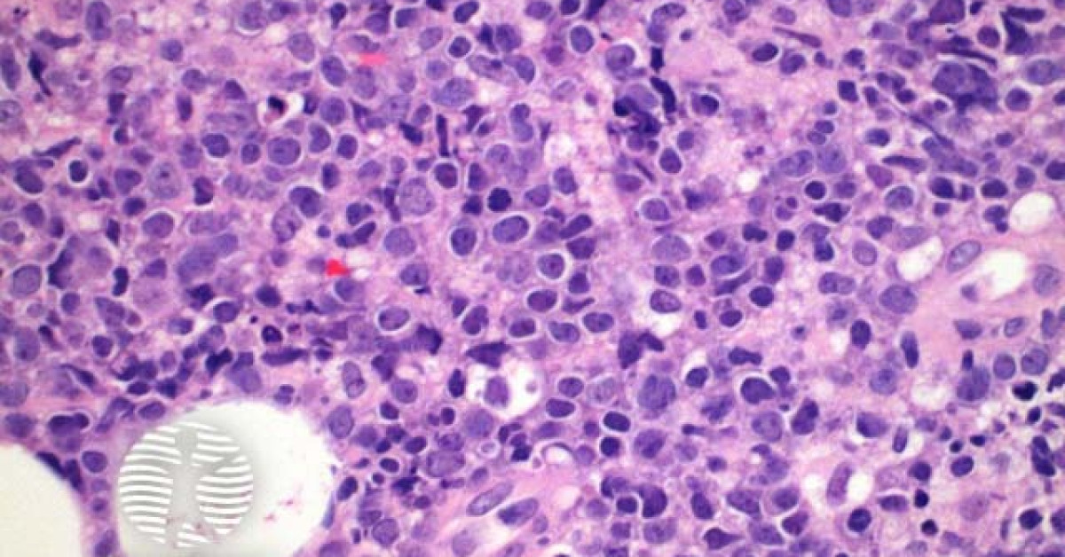 Dermnet Primary Cutaneous Diffuse Large B Cell Lymphoma Pathology Image