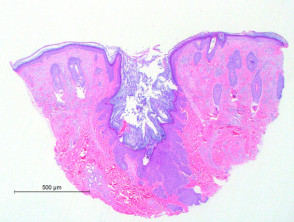Dilated pore of Winer pathology