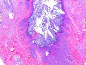Dilated pore of Winer pathology