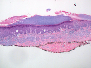Porokeratosis pathology