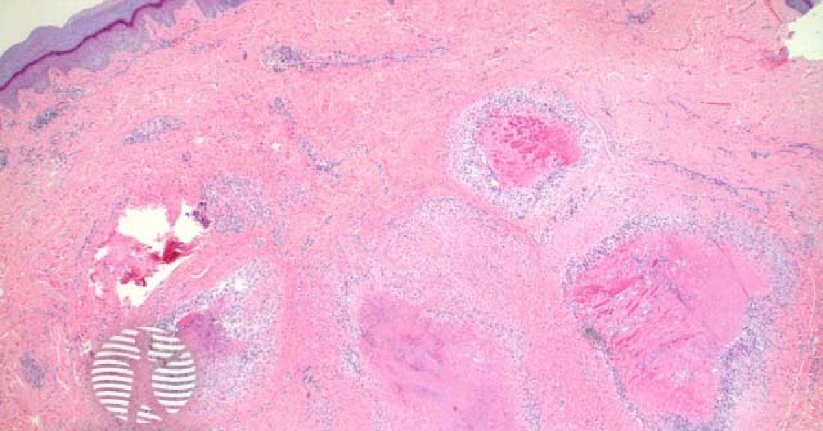 Rheumatoid Nodule Pathology Image