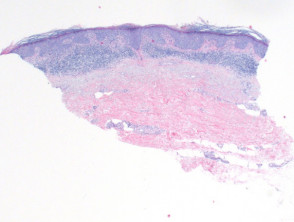 Squamous cell carcinoma in situ pathology