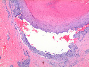 Trichilemmal cyst pathology