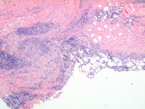 Necrobiosis lipoidica pathology