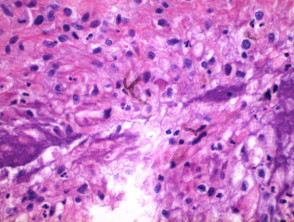 Phaeohyphomycosis pathology