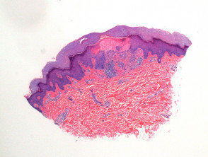 Lichen nitidus pathology