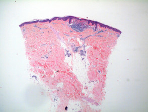 Lichen nitidus pathology