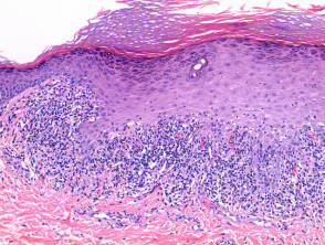 Lichen planus pathology