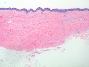 Lichen sclerosus  pathology