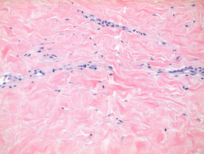 Lichen sclerosus pathology