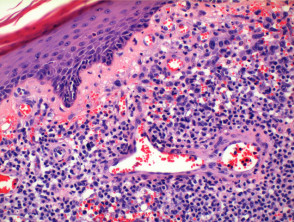 Lymphomatoid papulosis  pathology