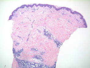 Subcutaneous panniculitis-like T-cell lymphoma pathology