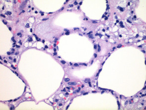 Subcutaneous panniculitis-like T-cell lymphoma pathology