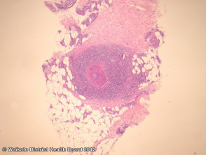 Polyarteritis nodosa pathology