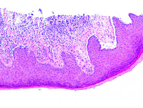 Brunsting-Perry cicatricial pemphigoid pathology