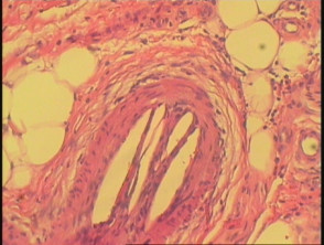 Cholesterol emboli pathology