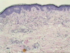 Pathology of cutis laxa