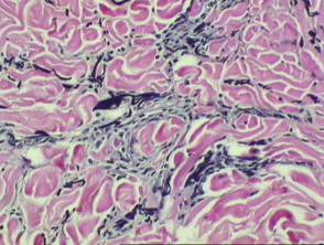 Pathology of cutis laxa