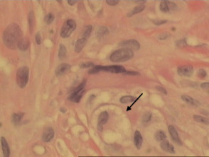 Necrobiotic xanthogranuloma pathology