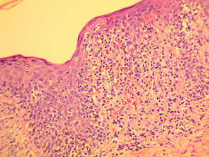 Pityriasis lichenoides et varioliformis acuta (PLEVA) pathology