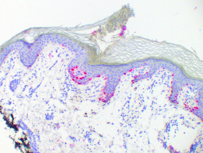 Pigmented porokeratosis (Melan A)
