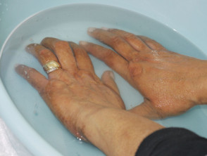 Hands and feet PUVA soaks