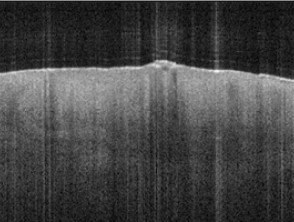 Optical coherence tomography of SCC in situ