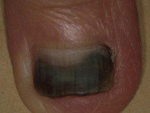 Pseudomonas stained nail
