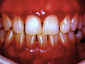 Cutaneous adverse reaction to anticonvulsant, gingival hyperplasia