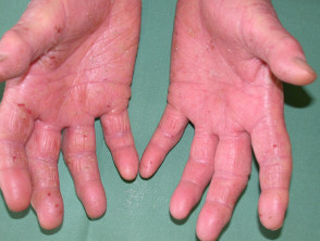 Hand dermatitis in hairdresser