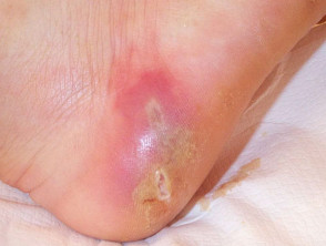 Cellulitis in cracked heel