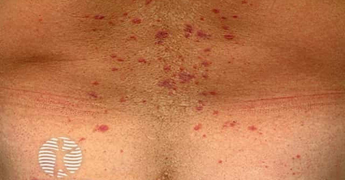 Lichen Planus Image