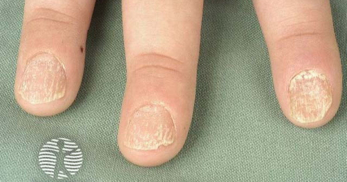 Dermnet Nail Psoriasis Image