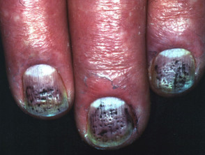 Nails in psoriasis