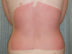 Photosensitive and koebnerised plaque psoriasis arising after mild sunburn
