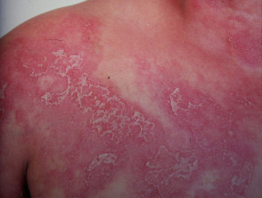 Subcorneal pustular dermatosis